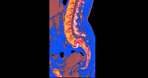 Ct Scan Lumbar Spine Diagnosis Backache Stock Footage Video (100% Royalty-free) 1093395223 | Shutterstock