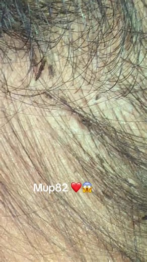 Effective Lice Removal Strategies