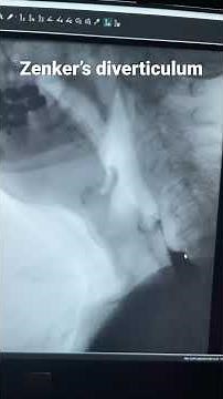 Mechanism of Zenker’s diverticulum seen on X ray fluoroscopy