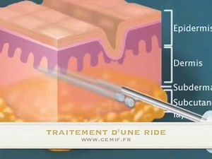 TRAITEMENT DES RIDES