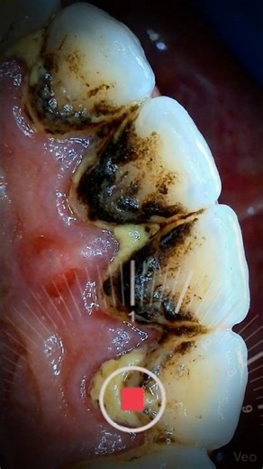 You won't believe the decay I removed after 50 years! #asmr