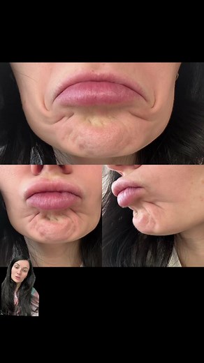 Chin & DAO Botox or Dysport • • • #dallasinjector #botoxbeforeandafter #chinbotox #DAObotox #botox #injections #dallasfiller #injector #fillerdallas #dallasinjections #dallasesthetician #smoothskin #dallasbotox #dallasdysport #dallasmedspa #dallasskincare #chindimple #dallasbestinjector #fyp #dfwinjections #injectables #dysportbeforeandafter #dysport