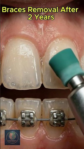 Braces Journey Complete | 2-Year Smile Transformation