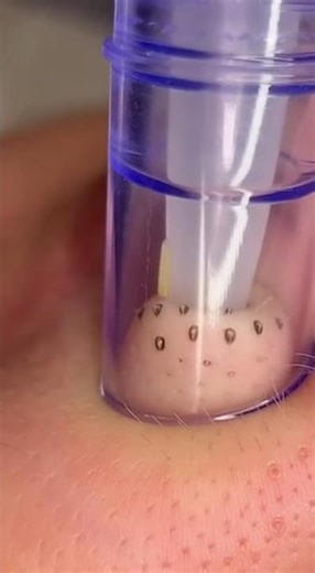 Deep Pore Cleansing: Blackhead Removal Tool Demonstration