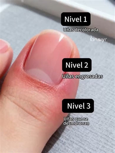 Livre-se dos fungos nos pés de maneira simples!” 👣 Comichão, mau cheiro e irritação não precisam mais incomodar. ✔️ Combatem os fungos eficazmente ✔️ Diminuem comichão e odor ✔️ Fácil de aplicar nos pés ✔️ Confortável durante todo o dia e noite 🔥 Seus pés saudáveis e frescos em cada passo.