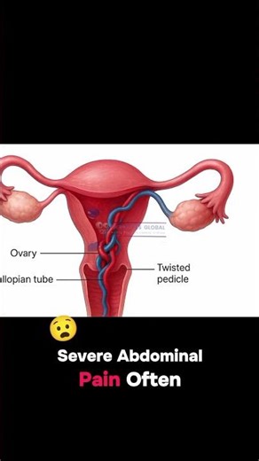 Ovarian torsion #ovariantorsionsymptoms #gynecologicalemergency #ovariancysttorsion