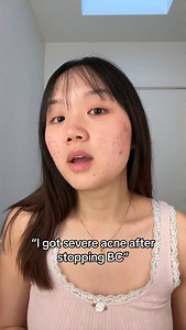 The funny thing is that I’ve gone back on birth control because I couldn’t handle my acne. Then I realized it’s not a long-term solution. As a society, we don’t fully acknowledge how much birth control impacts our hormones. The side effects are real, and masking symptoms isn’t the same as healing 🥹❤️‍🩹 #acne #hormonalimbalance #hormonalacne #acnetips #birthcontrol #clearskin #acneawareness #acneskincare | Grace May