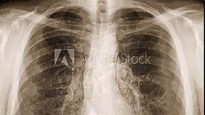 X-ray of chest covered with transparent skin. (loop ready file)