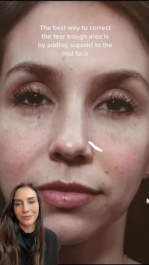 My first filler treatment 10 years ago - 1 ml of filler to the mid face/ cheek area. Many patients come in asking to fix their tired looking eyes with tear trough filler. However, filler in the tear trough area can lead to swelling and complications. The best way to fix the tear trough deformity is by placing filler to the mid face. #facebodyboutique #filleramsterdam #naturalresults #fillersinjection