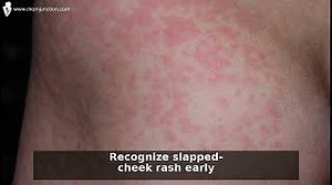 All You Need To Know About Fifth Diseases (Slapped Cheek Disease) Video - MomJunction