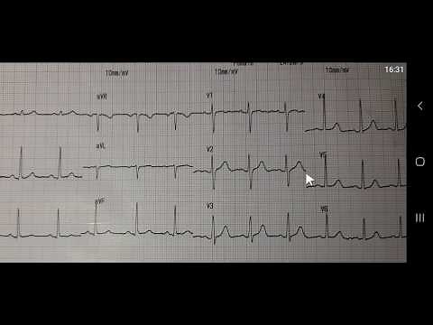 ECG Hướng dẫn đọc ECG cơ bản