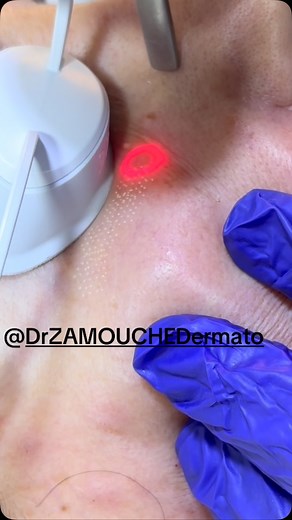 Blepharoplastie au laser CO2 permet de traiter la zone péri oculaire rides ridules poches relâchement et autres@drzmaouche#blepharoplasty #laserco2 | Dermatologue Cheraga - Dr. ZAMOUCHE