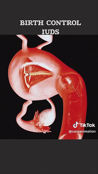 Intrauterine Device (IUDs) For Birth Control #iud #intrauterinedevice #birthcontrol #ludinsertion #birthcontrolawarness