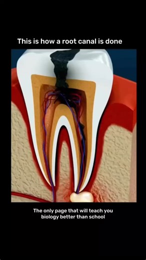 medical / biology explain on Instagram: "FOLLOW US FOR MORE - Root canal treatment is a dental procedure used to save a damaged or infected tooth 🦷. The dentist removes the infected pulp 🧫, cleans and disinfects the root canals 🧼, then fills and seals them 🪛. Finally, the tooth is restored with a filling or crown 👑 to bring back its strength and function. #interestingfacts #didyouknow #knowledgeispower #factsoftheday #dailyfacts #mindblowingfacts #knowyourworld #amazingfacts #curiosityunloc