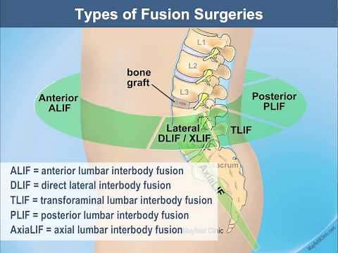 Same Day Lumbar Spine Fusion Surgery