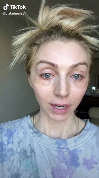 Day 5 TCA Peel for Under Eye Wrinkles