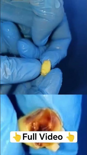 Stop Perforating! Perfect Endo Access in 60s