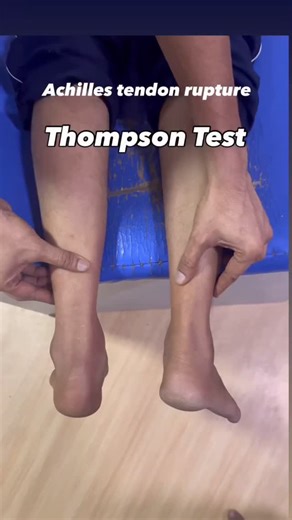 Clinical Nurse on Instagram: "Thompson Test (Calf Squeeze Test) Thompson test is a simple clinical test used to check for Achilles tendon rupture. How it's done 1. Patient lies prone (on stomach) with feet hanging off the edge of the bed. 2. Examiner squeezes the calf muscle. Normal (Negative Test) When the calf is squeezed → the foot should plantarflex (point downward). This means the Achilles tendon is intact. Positive Test (Suggests Achilles Tendon Rupture) When the calf is squeezed → no plan