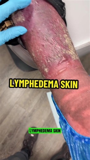 These legs are not just “swollen.” This is called lymphedema with something called lipodermatosclerosis. Let me explain it simply 👇🏾 Your body has tiny “drain pipes” that help move fluid out of your legs. When those pipes don’t work well, fluid builds up. That causes swelling. If the swelling stays there for a long time: • The skin can get hard • The legs can feel tight or heavy • The skin can turn dark or reddish • The shape of the leg can change It is NOT just a weight issue. It is NOT just 