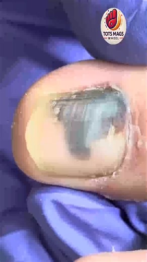 1.5K views | Smart Health Tips for Thickened Toenails Using Safe Home Products #SafeSteps #SeniorHealth #FootCareTips | Tots Mags Wheel | Facebook