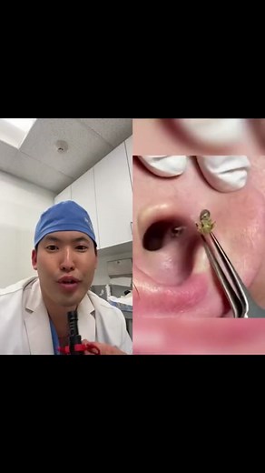 #duet with @AcneShot def a satisfying dilated pore extraction #dermatologistreacts #drsugaiskincare #dilatedpore #pimplepop #cystpop #acne