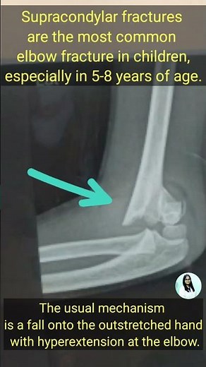 Supracondylar fracture of elbow | commonest fracture of children | gunstock deformity