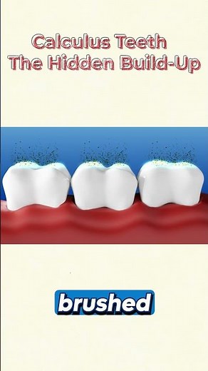 How often should you get your teeth cleaned to avoid calculus buildup?