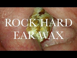 ROCK HARD : EAR WAX REMOVAL : 4K/HD
