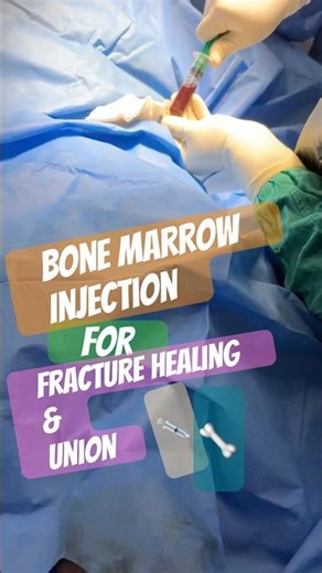 Bone marrow injection💉for fracture healing| #fractures #fracturetreatment #doctor #hospital #tips