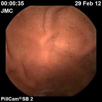 Cápsula Endoscópica PillCam - Esôfago e Estomago