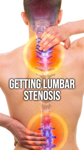 When we look at the low back from the side on X-ray, one of the most common issues we see is excessive lumbar curvature. That extra curve overloads the facet joints on both sides of the spine. Over time, those joints become irritated, arthritic, and inflamed. As that degeneration progresses, it can start to encroach on the space where the nerves exit, setting the stage for chronic back pain, severe arthritis, and eventually lumbar stenosis. This isn’t just a “back problem.” It’s a mechanics prob