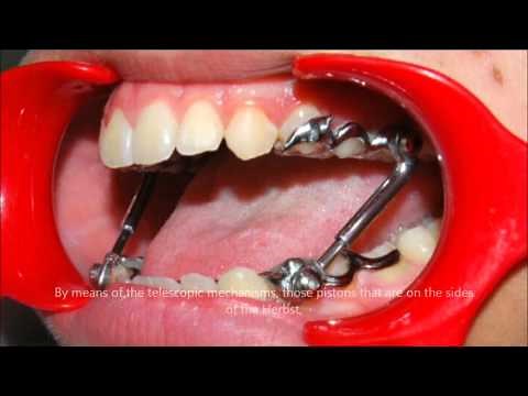 Presenting the Herbst appliance (An Introduction) | Tom Nasiopoulos Orthodontist