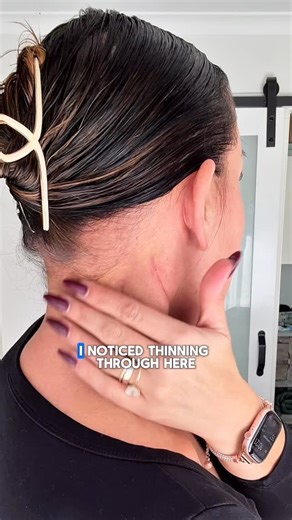 Chantelle Patu on Instagram: "☢️ CANCER HAIR LOSS ☢️ I have Nasopharyngeal Carcinoma—a 15mm tumour hiding at the top of my throat, behind my nose. I’ve already had a neck dissection (they took out a 5cm cancerous lymph node + 32 others), and now I’m deep in treatment: 7 weeks of daily radiation and 3 rounds of Cisplatin chemo. Here’s what I didn’t know until now: not all chemo makes your hair fall out. Cisplatin is a “maybe” chemo—some people lose it, some don’t. After 2 rounds, I’ve still got m