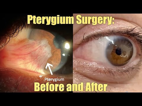 Ptergyium Surgery - Before and After. What is it? How we remove it. Recovery and Results.