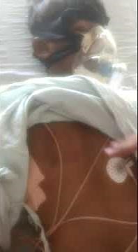 Paradoxical breathing flail chest