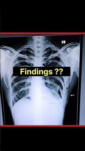 Surgical Emphysema Chest X-Ray Findings #shorts