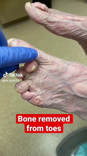 Bones Removed from Toes Due to Failed Hammer Toe Surgery