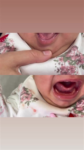 Frenectomía Lingual en Bebé de 1 Mes: Acople y Alimentación