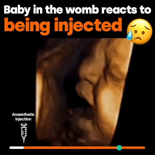 Baby in the womb reacts to being injected 😢 This baby received the anaesthetic injection into their thigh ahead of life saving intrauterine surgery. During a late-term abortion of a baby at the same age, a lethal injection of potassium chloride is usually injected into their heart. Potassium chloride is the same chemical used to execute inmates in the US. The administration of potassium chloride in executions is considered so painful that it is considered necessary to first administer an anaest
