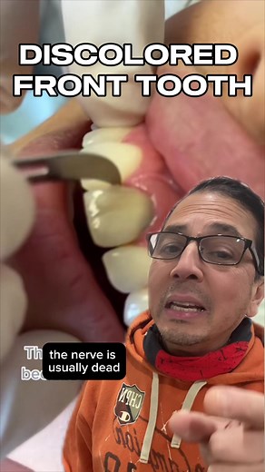 A dead tooth, also known as a non-vital tooth, occurs when the pulp inside the tooth dies due to infection or injury, losing its blood supply. This can result in discoloration, typically appearing gray or dark yellow. While a dead tooth may not cause immediate pain, it requires dental attention to prevent complications and maintain overall oral health. #deadtooth #rootcanal #dentalcrown #teeth #tooth #restorativedentistry #dentist #dental #dentistryworld #dentistry #dentalcare #dentalprocedure #