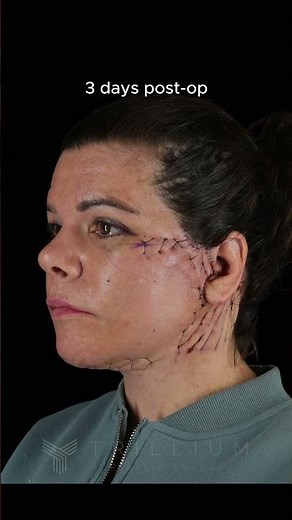 Facelift Recovery Timeline: Before, 3 Days, 1 Week & 6 Weeks After