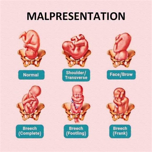 16K views · 30 reactions |  Baby Presentations at Birth 擄 Cephalic (Head first) – Most common, safest  Breech (Butt/feet first) – May need C-section ️ Transverse (Sideways) – Needs medical help ⚖️ Doctor checks position near due date  Exercises & medical guidance may help baby turn #BabyPresentation #PregnancyFacts #BirthPreparation #MomTips #PregnancyJourney | Mum_world_ | Facebook