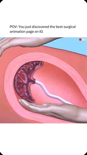 Animations on Instagram: "Follow @surgicalanimation for more! 🏥"