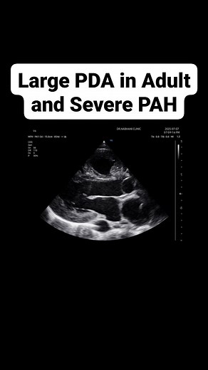 Large Patent Ductus Arteriosus (PDA) in Adult and Severe Pulmonary Artery Hypertension (PAH) 18-year-old male presented. With dyspnea, oxygen saturations in the toes (94%) compared with his fingers (96%) TTE: LV EDD: 6 cm, ESD: 3.96 cm LA: 4.12 cm Mild MR 1/4 Mild AR 1/4 Dilated RV & RA Moderate TR 2/4 with SPAP: 102 mmHg Dilated PA: 6.62 cm PR with DPAP: 64 mmHg PV M Mode: Absent a Wave. And Mid Systolic Closure (MSC) Large PDA: 12.6 mm with Bidirectional Shunt Intact IVS & IAS | Mhd Fawzi Nabh