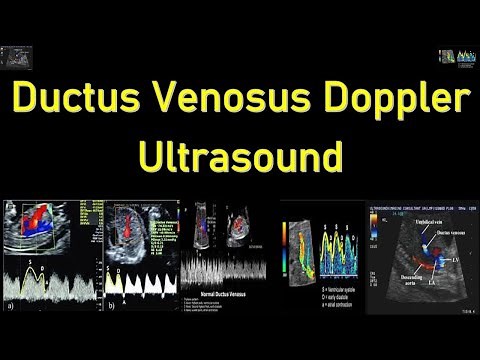 Fetal Ductus Venosus Doppler Ultrasound Interpretation