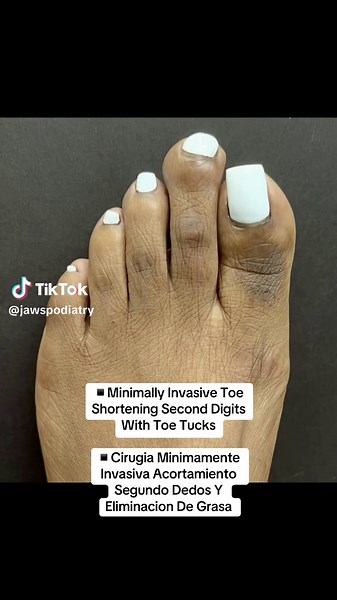#CapCut MINIMALLY INVASIVE TOE SHORTENING & TOE TUCK SURGERY 🤩 CIRUGIA MINIMAMENTE INVASIVA PARA EL ACORTAMIENTO DE LOS SEGUNDO DEDOS Y ELIMINACION DE GRASA 🤩 👠Cosmetic Foot Surgery / Cirugia Estetica Del Pie 🇺🇸Miami, Florida 🇨🇴Cartagena, Colombia ☎️ 954-922-7333 ✅ WhatsApp: 1-305-965-3074 (EEUU) 👨🏻‍⚕️To set up a consultation, please fill in the link in the bio / Para programar una consulta, por favor llene el enlace en la biografía. 📧 Mifas@Jawspodiatry.com 💳 Financing Available / Fi