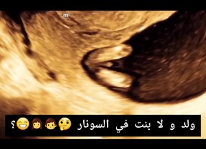 احجزي معادك الان تطمني عالبيبي و نعرفك النوع اسرع من اي دكتور او مركز تاني، و فيه سونار منزلي كمان 💪 https://wa.me/201224243716 و اشتركي في جروب معرفه النوع مبكرا مع #د_هيثم_عارف احسن دكتور سونار نسا و توليد في مصر https://www.facebook.com/groups/UUUnit/ و اشتركي في قناتنا عاليوتيوب الان و فعلي الجرس لتصلك التنبيهات https://youtu.be/Pz3KGKjYCmU و نزلي ال app https://play.google.com/store/apps/details?id=com.ultrasca و شوفي الويبسايت بتاعنا www.ultrascan4d5d.com و اشتركي في جروب التلجرام https:/