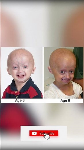 How long do progeria patients live 😳! Why do they age faster?