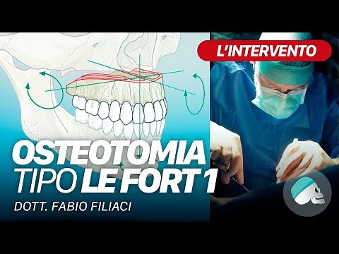 Chirurgia ortognatica - Osteotomia tipo Le Fort I - Video intraoperatorio