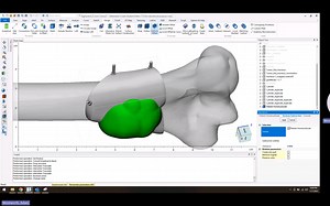 3matic术前模拟切除/导板设计